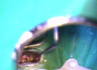 メタルガッタパーチャを取っていく 2 2017.01.06.gif